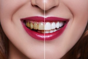 Are veneers safe