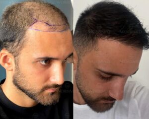 Hair transplant in Turkey