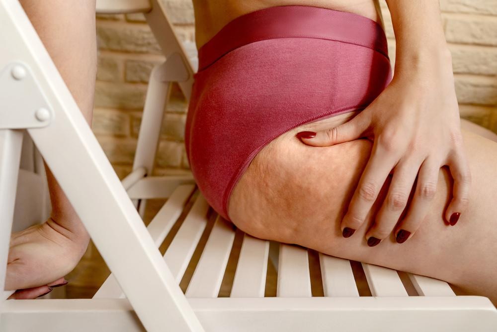 Calculate Your Cellulite Score
